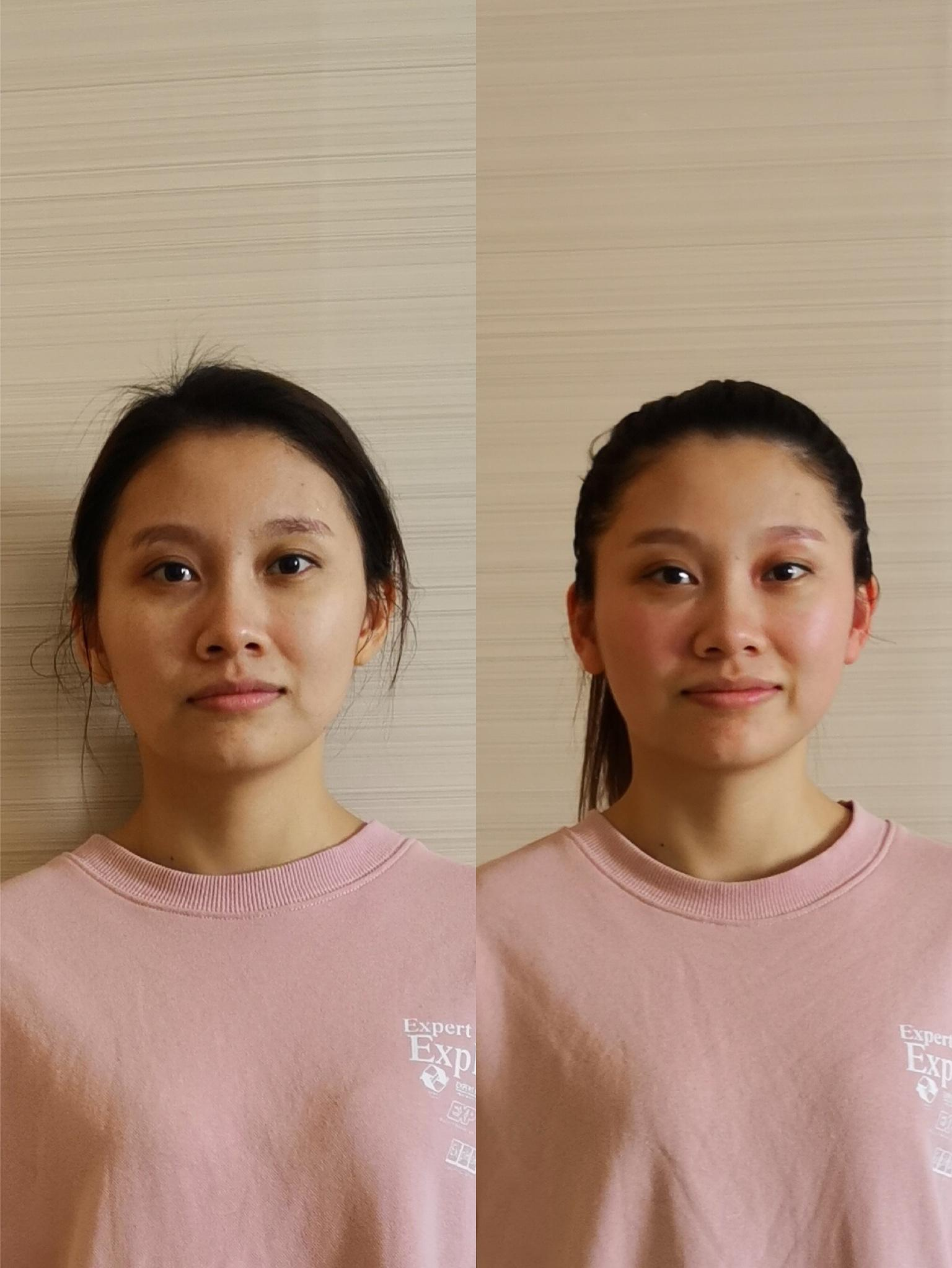 脸部矫正前后对比