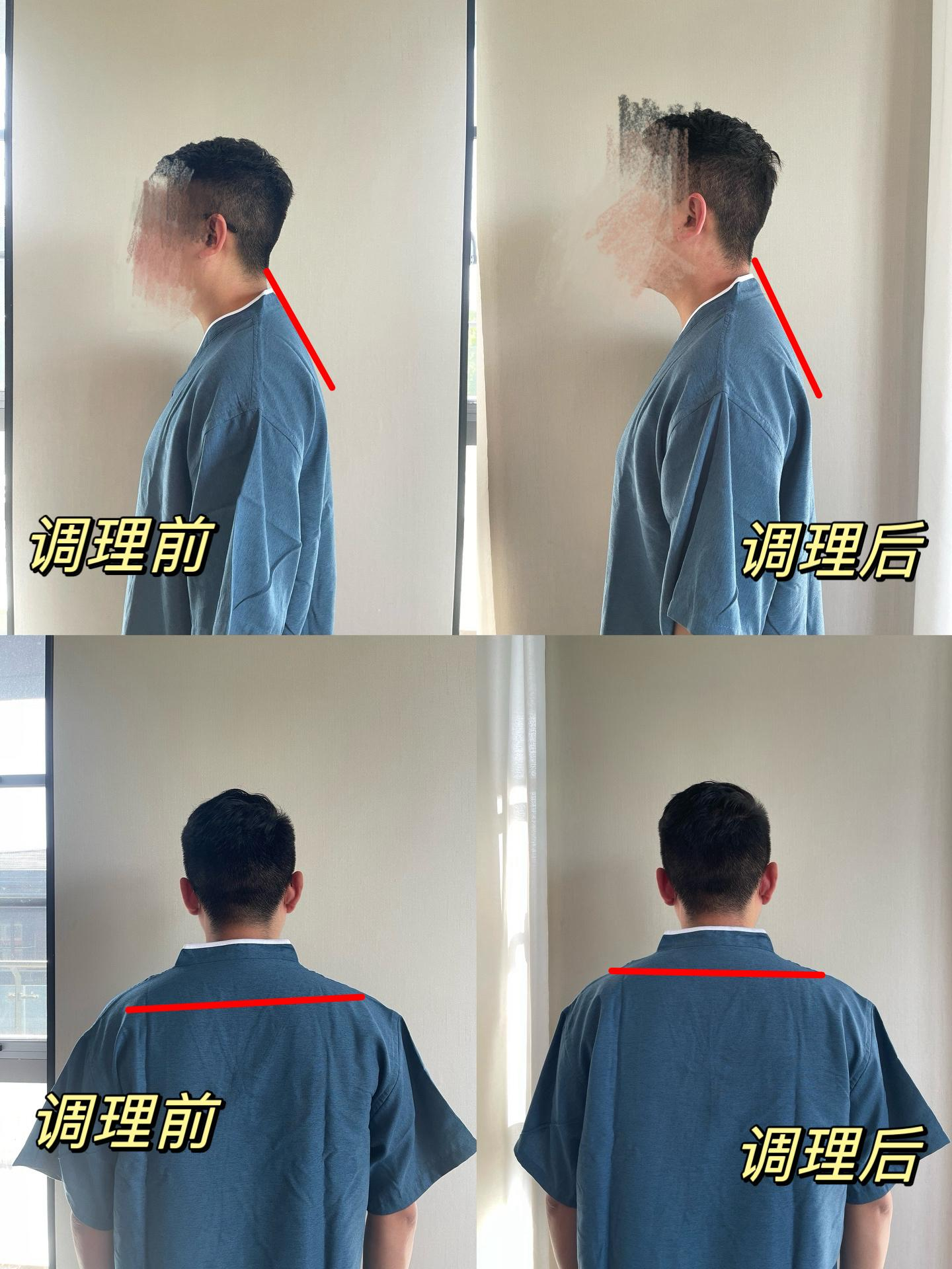 脊椎调整案例1
