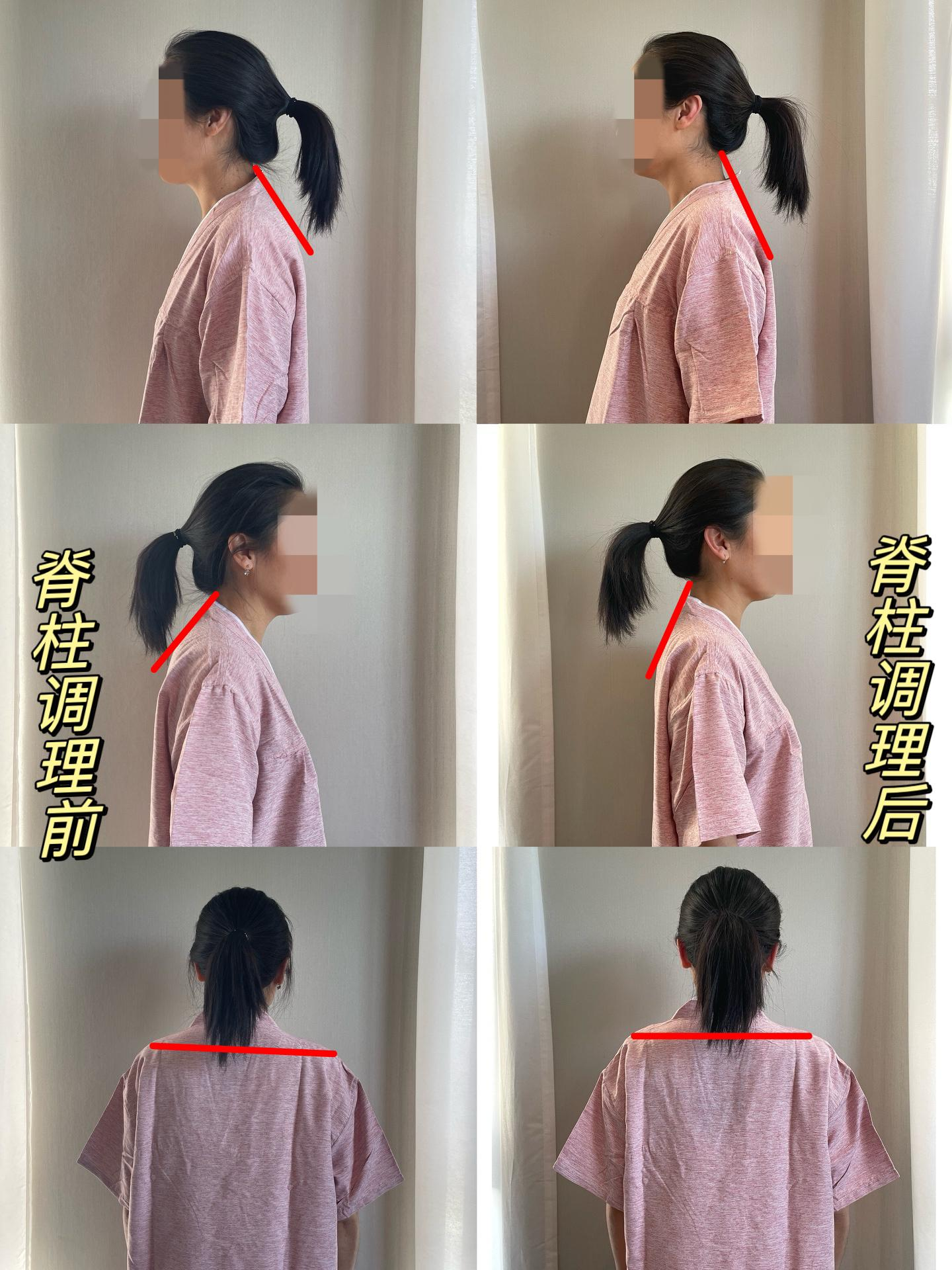 脊椎调整案例2