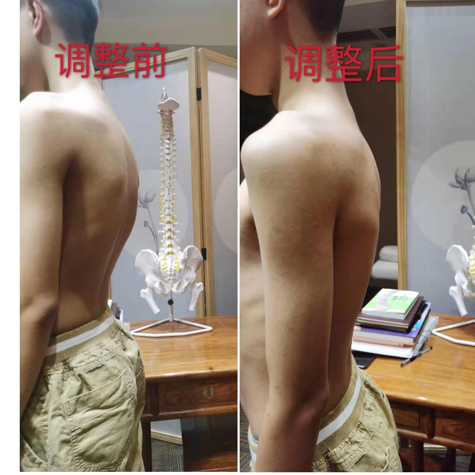 脊椎调整案例3